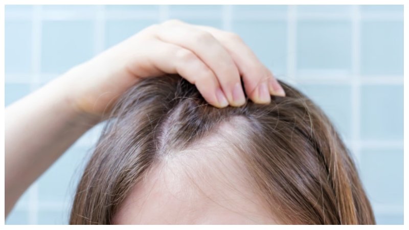 Scalp Micropigmentation